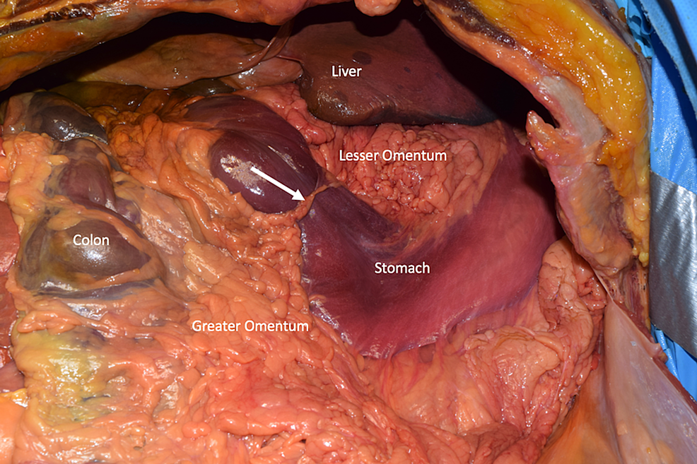 Cureus Constriction Of The Stomach By An Unusual Peritoneal Band