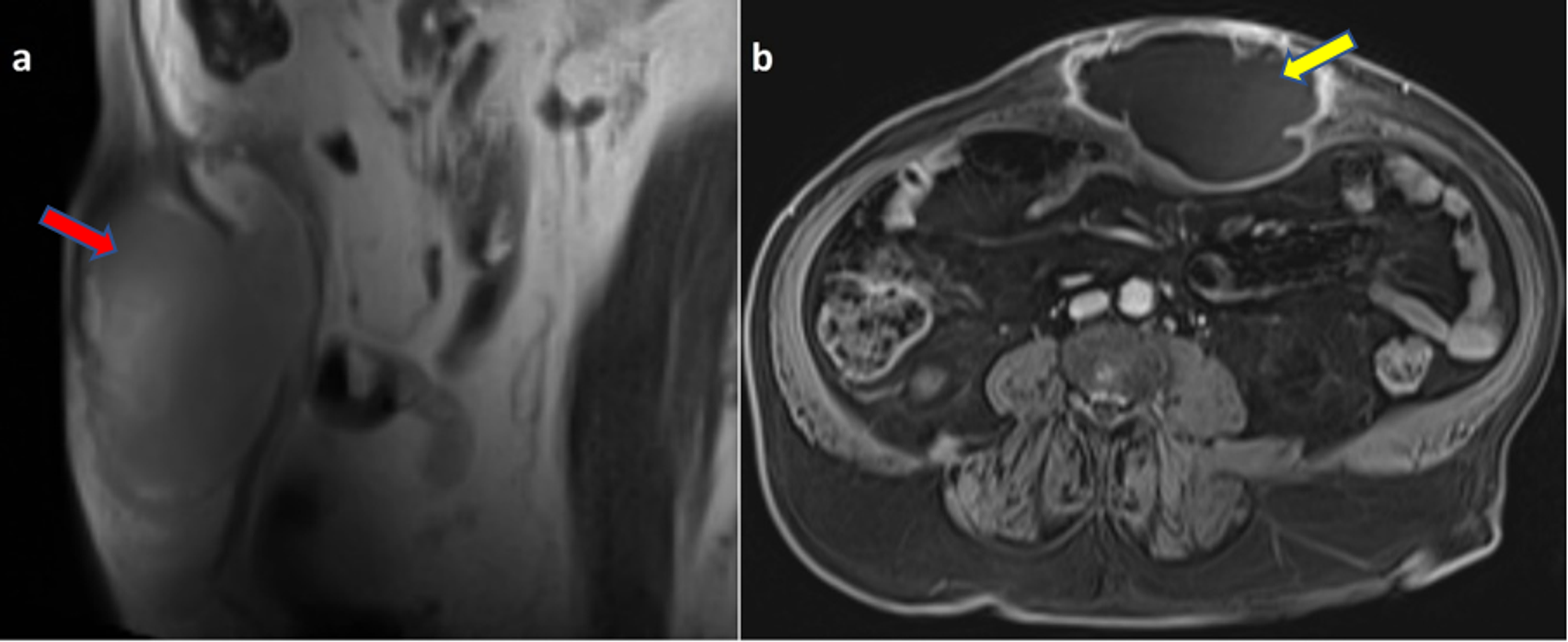 Cureus Rare Case of Primary Anterior Abdominal Wall Abscess