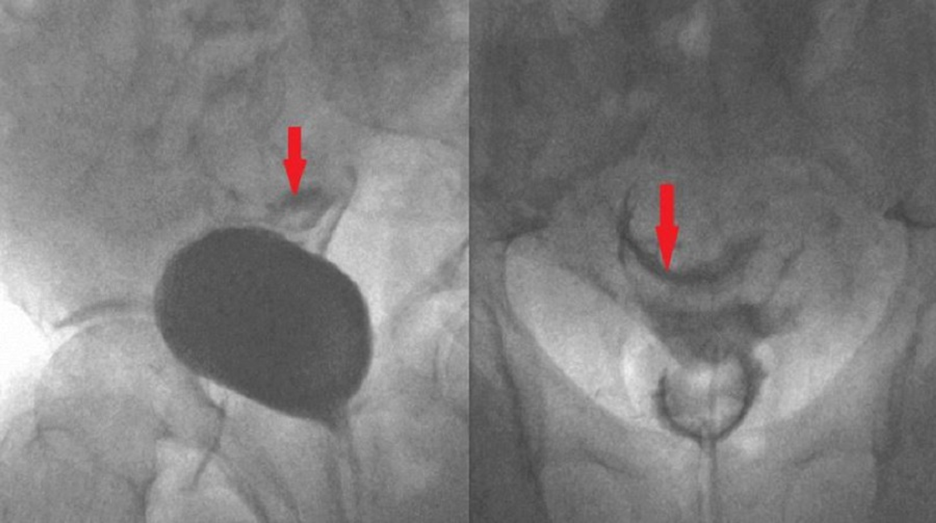 Cureus Laparoscopic Repair of CatheterInduced IntraPeritoneal