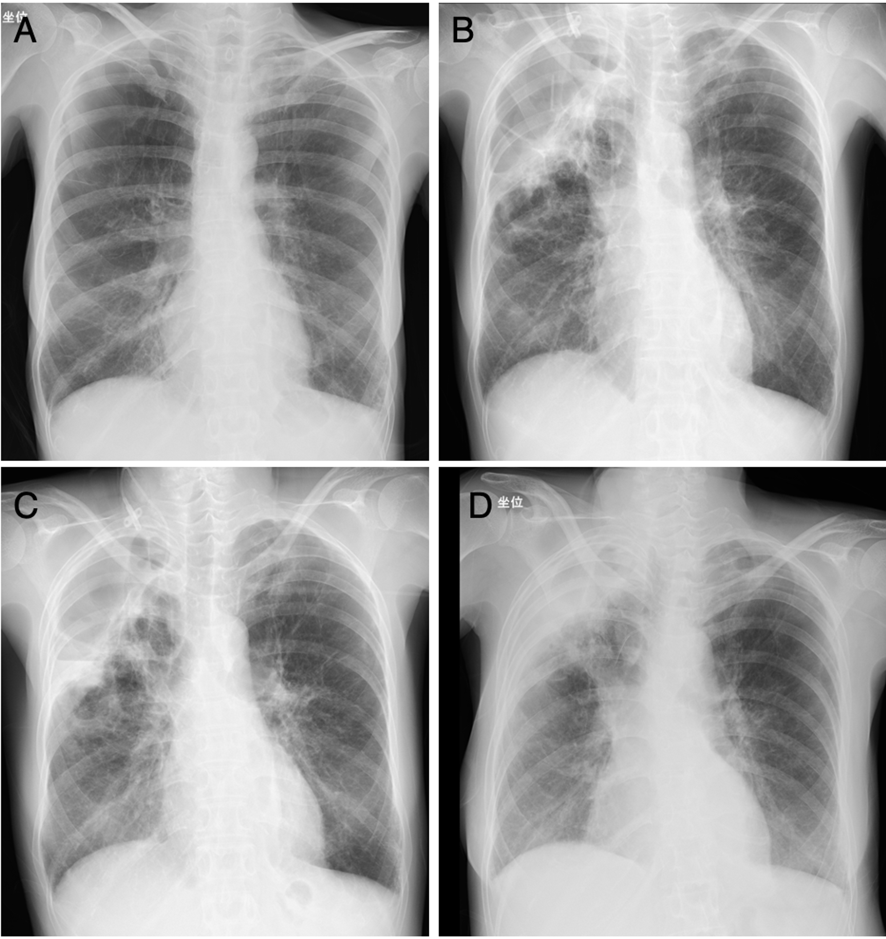 A Refractory, Infected Lung Bulla and an Abscess Treated Using ...