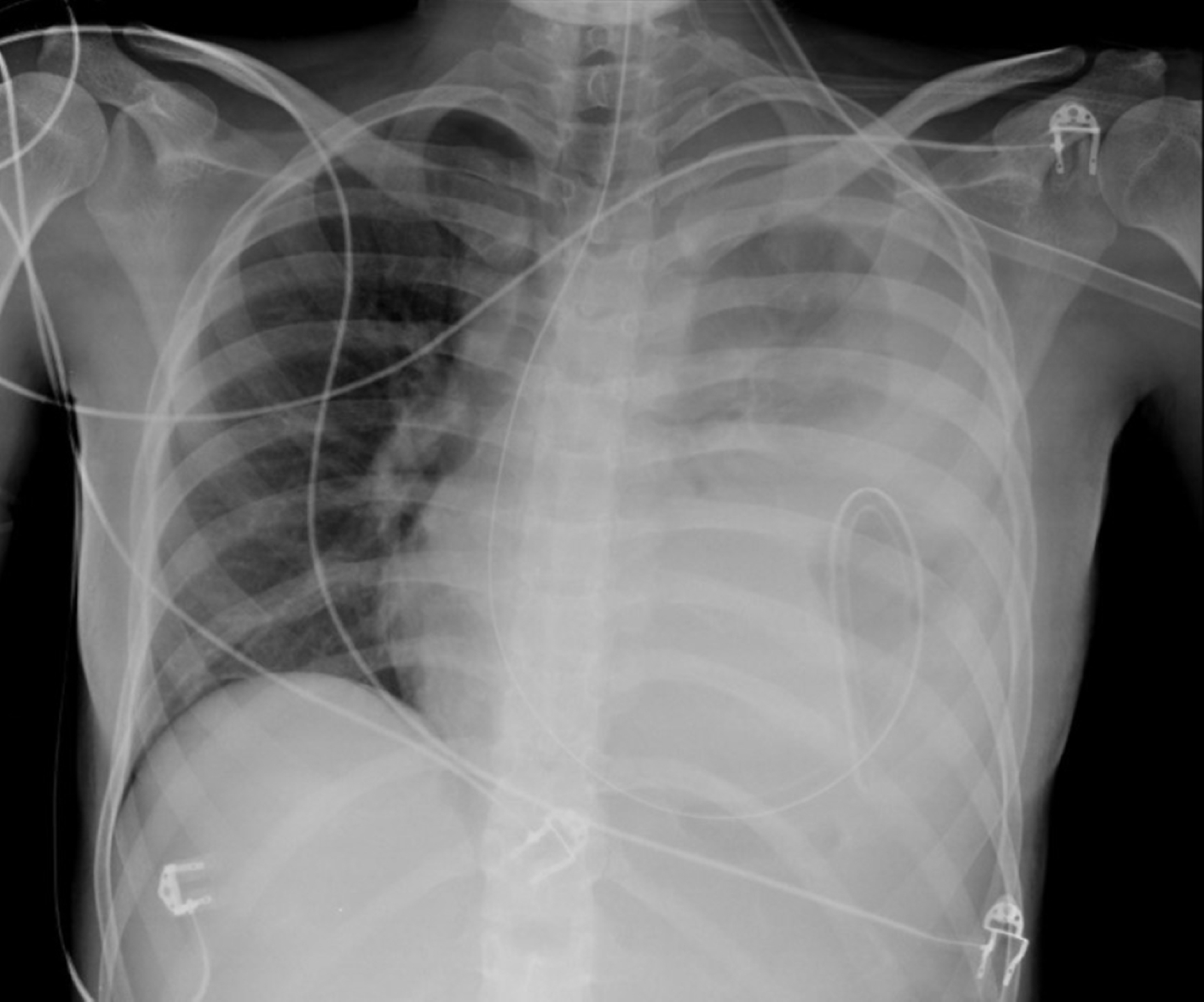 Cureus | Passing Through a Hole: Delayed Diaphragmatic Hernia After ...