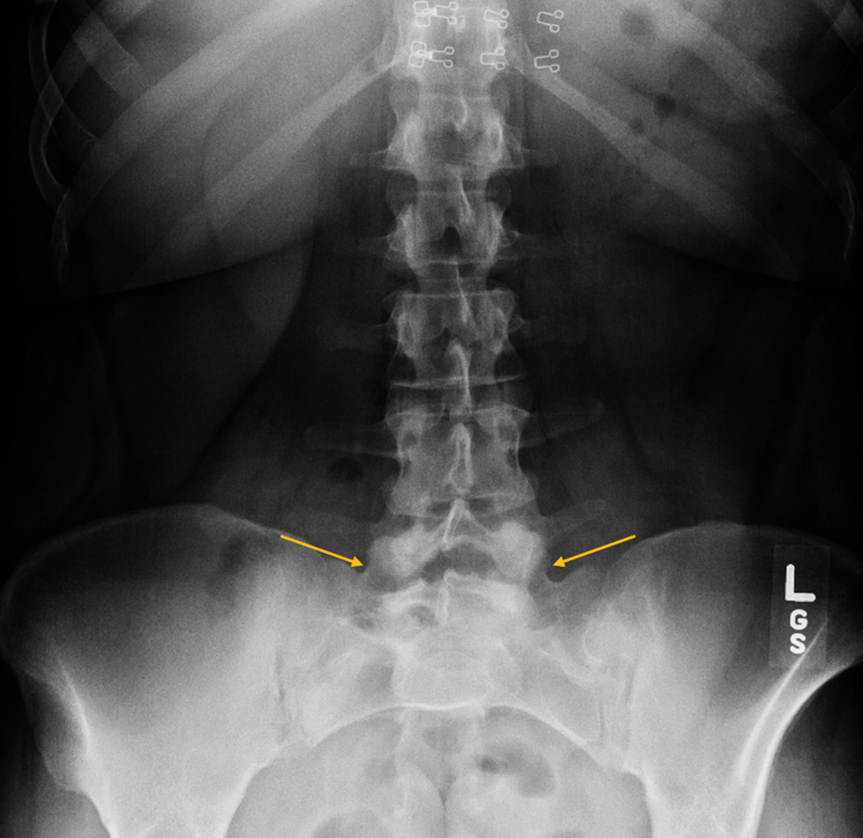 Cureus | A Rare Streptomyces Infection of the Sacroiliac Joint: A Case Report | Article