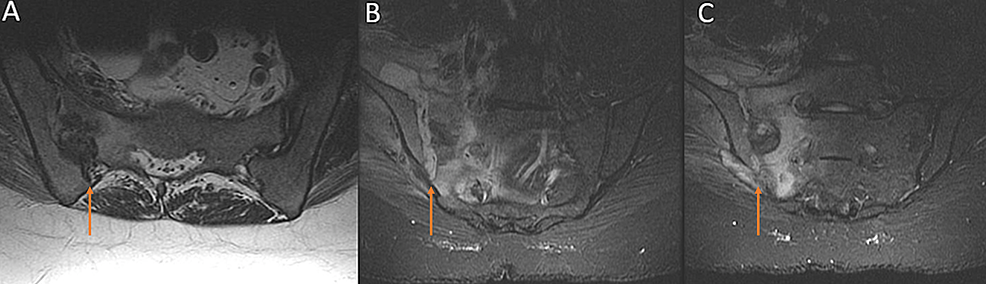 Cureus | A Rare Streptomyces griseus Infection of the Sacroiliac Joint ...