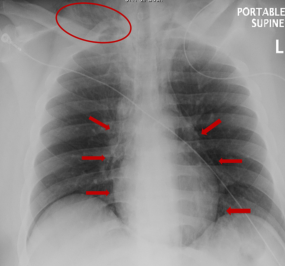 Spontaneous Pneumomediastinum as a Consequence of Severe Vomiting in ...