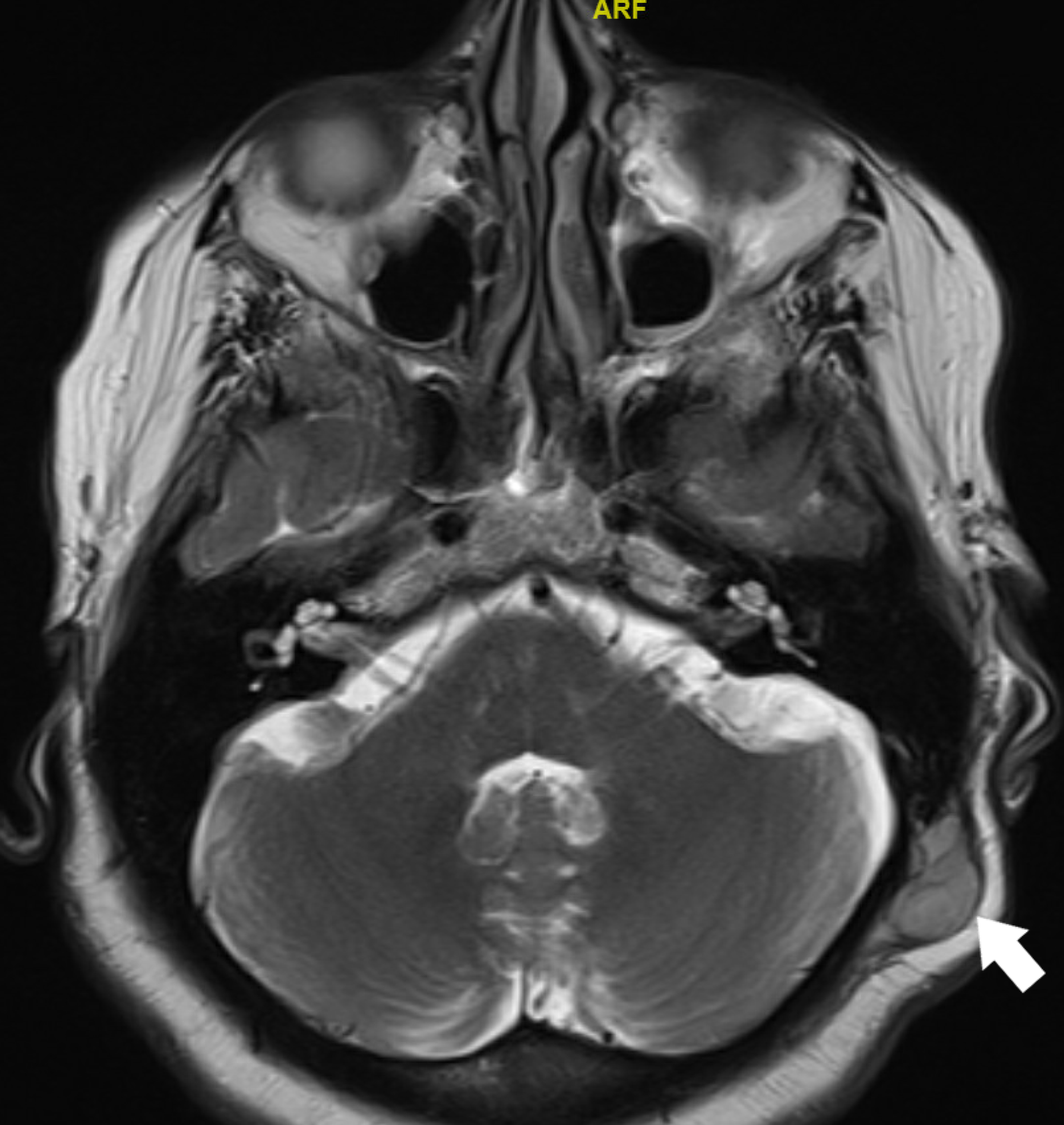 Cureus | Spindle Cell Squamous Cell Carcinoma of the Scalp Treated With ...