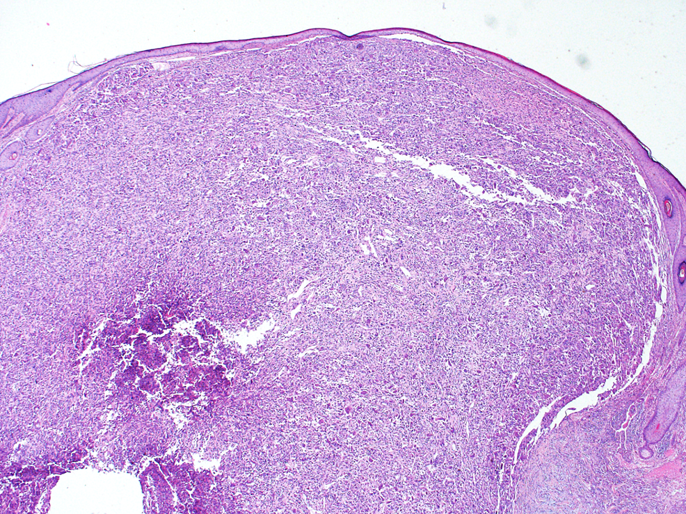 Cureus Spindle Cell Squamous Cell Carcinoma of the Scalp Treated With
