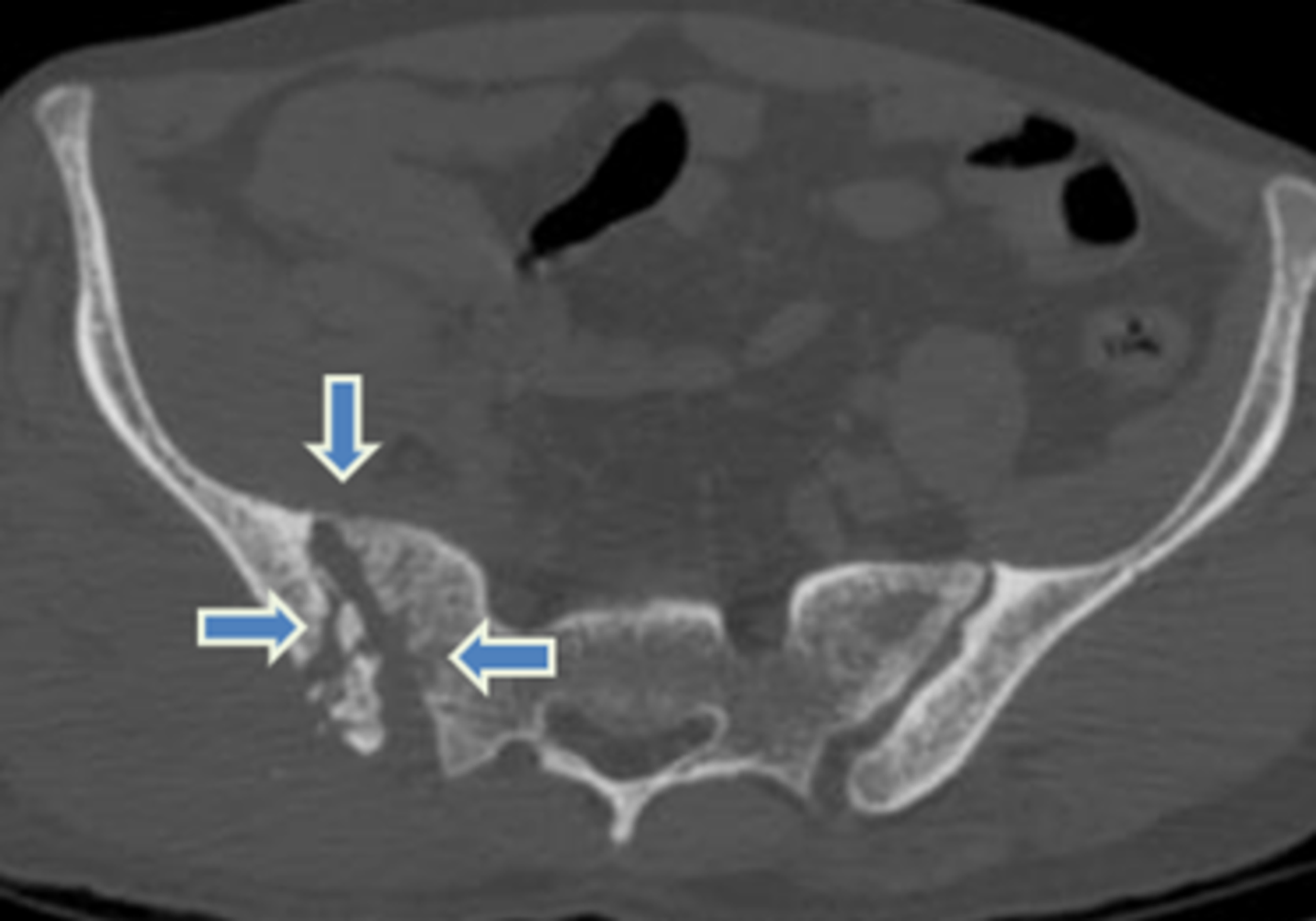 Cureus Chronic Pelvic Osteomyelitis Case Report Of A Rare Complication Of Bone Marrow Biopsy