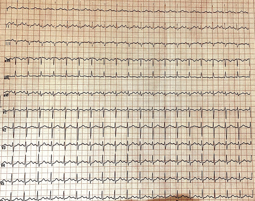 Cureus Atrial Tachycardia Masquerading As Inappropriate Sinus