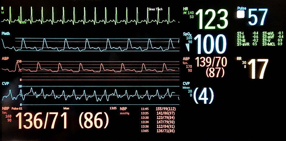 Cureus | A Premature Ventricular Contraction Associated With Transient ...