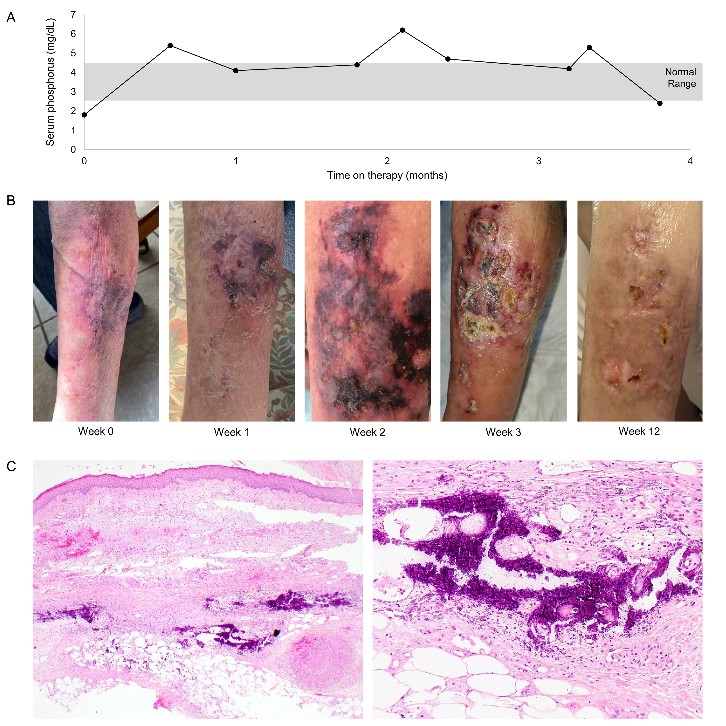 calciphylaxis treatment