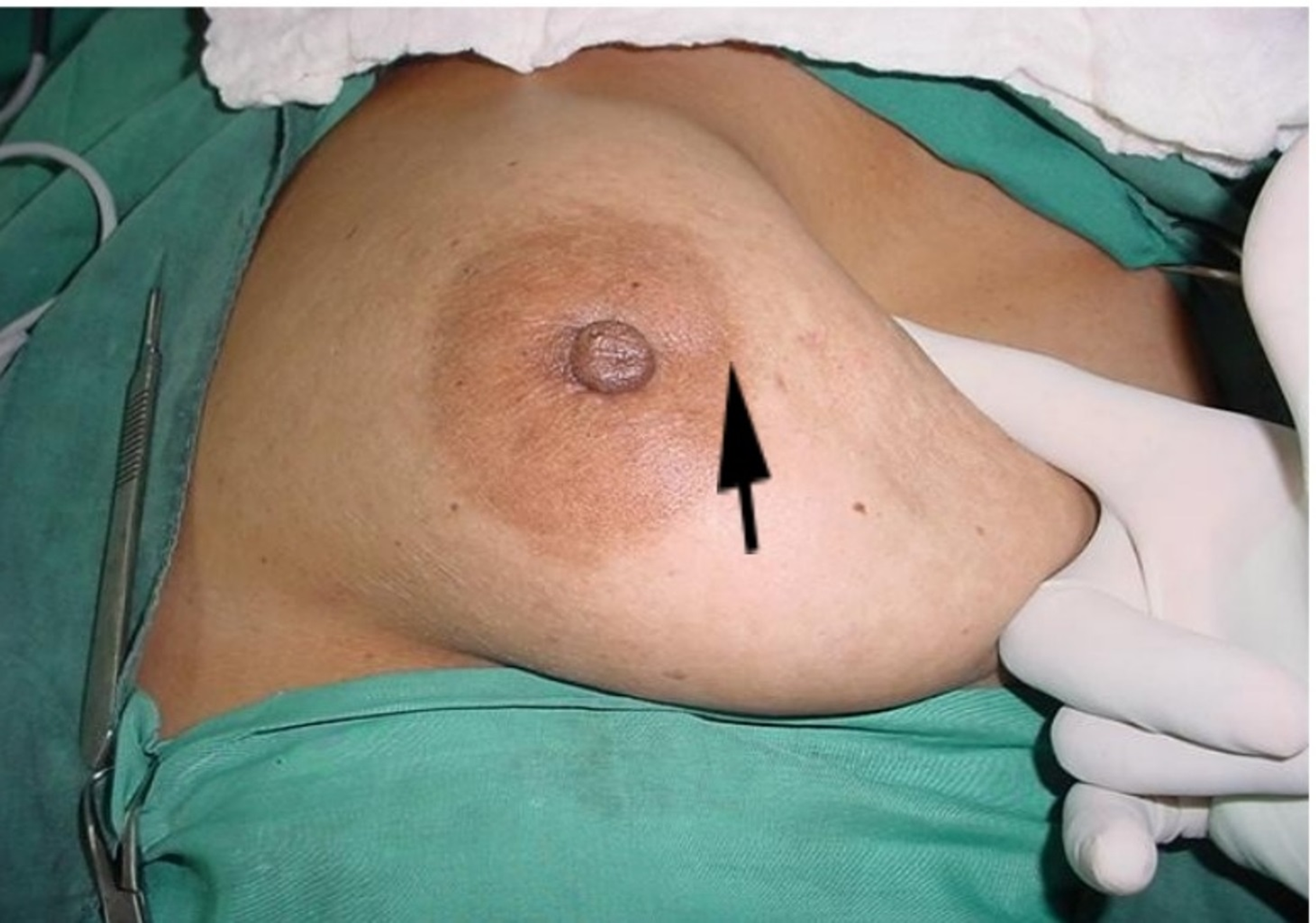 Cureus | The Pushing Sign for Early Skin Tethering in Breast Cancer