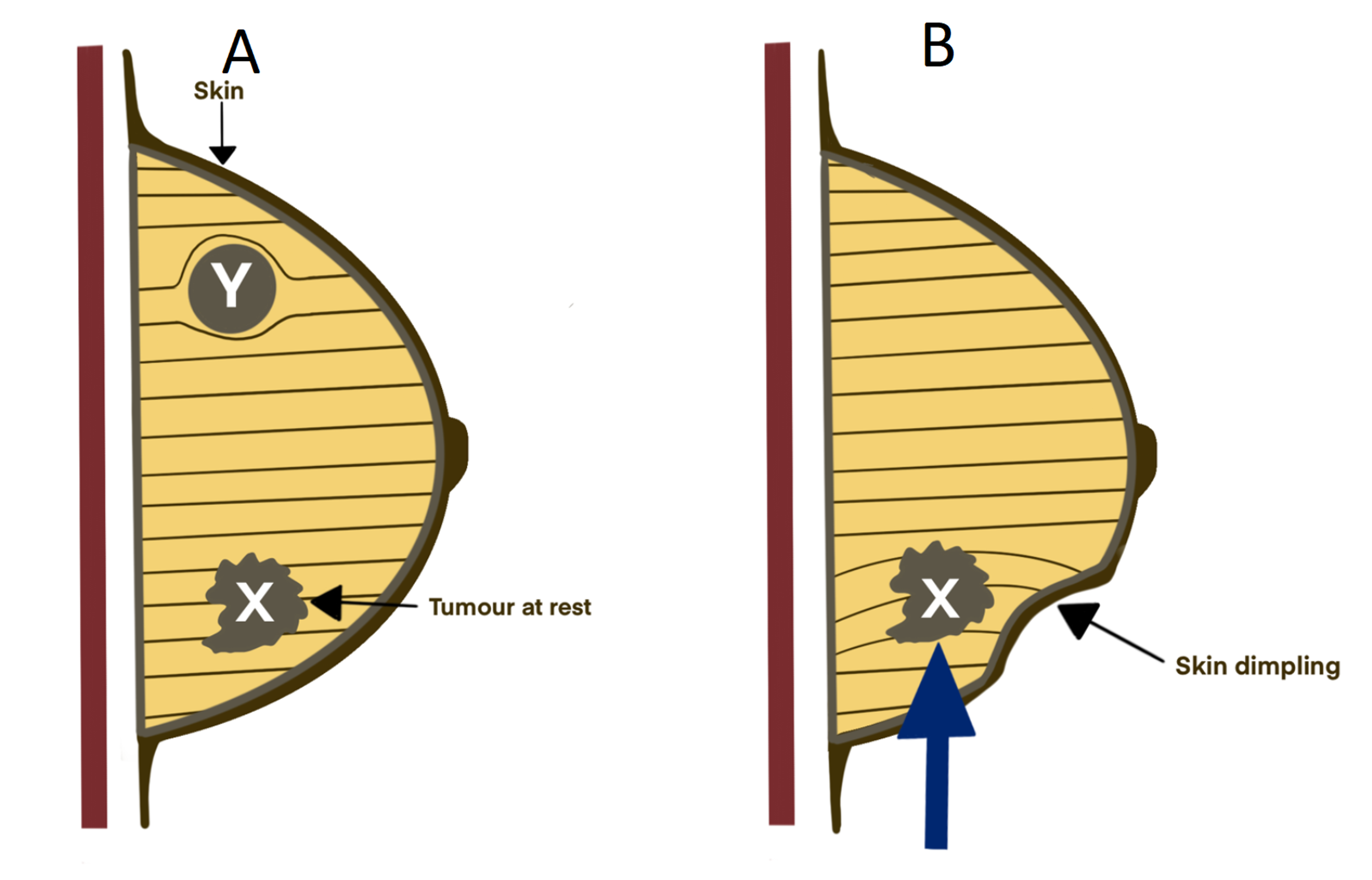 Cureus The Pushing Sign for Early Skin Tethering in Breast Cancer