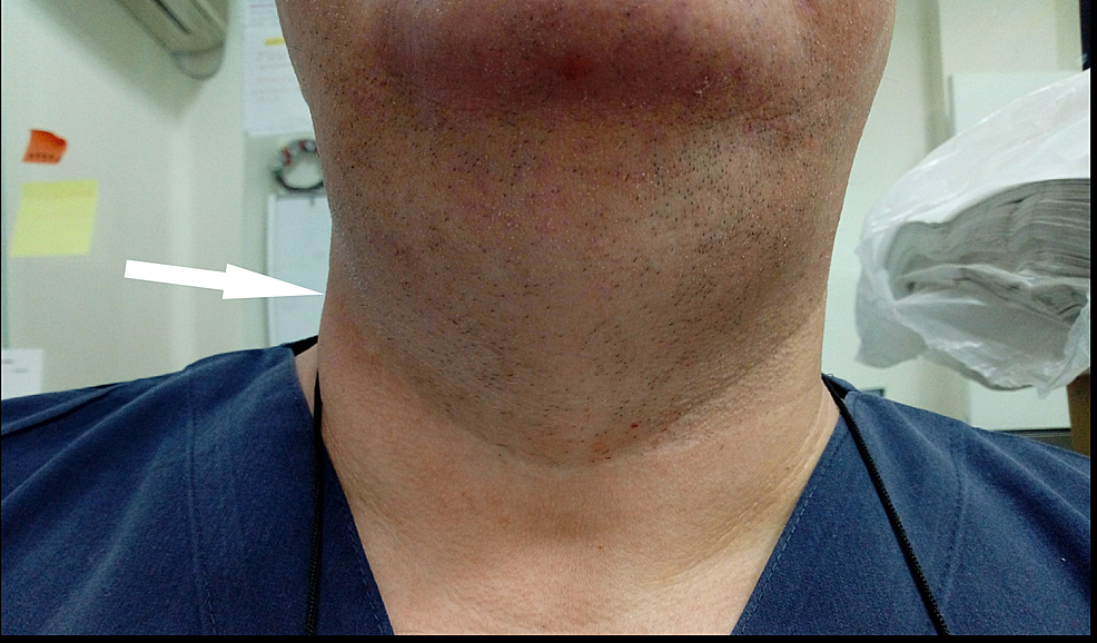 glp 1 lump in neck A Rare Case of Dulaglutide-Associated Angioedema in a Male Patient