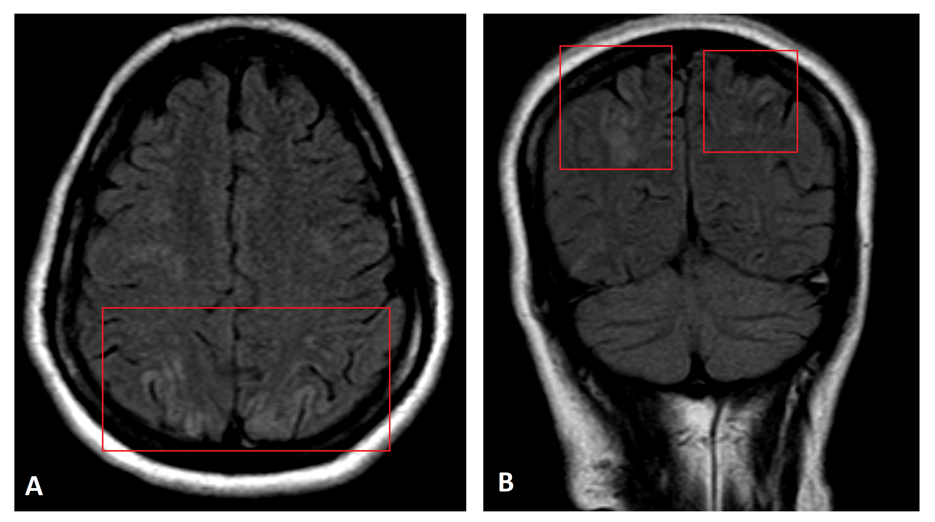 Cureus Postpartum Eclampsia Complicated With Posterior Reversible