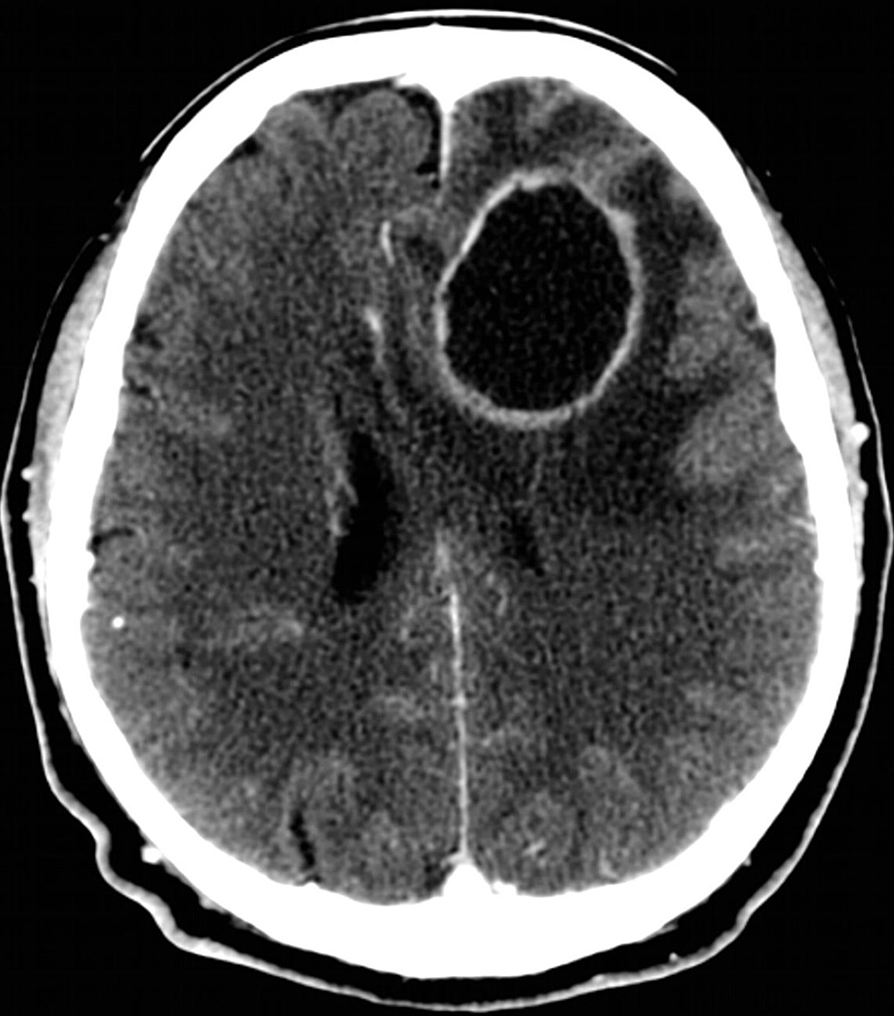 PDF] Restricted diffusion within ring enhancement is not pathognomonic for  brain abscess. | Semantic Scholar