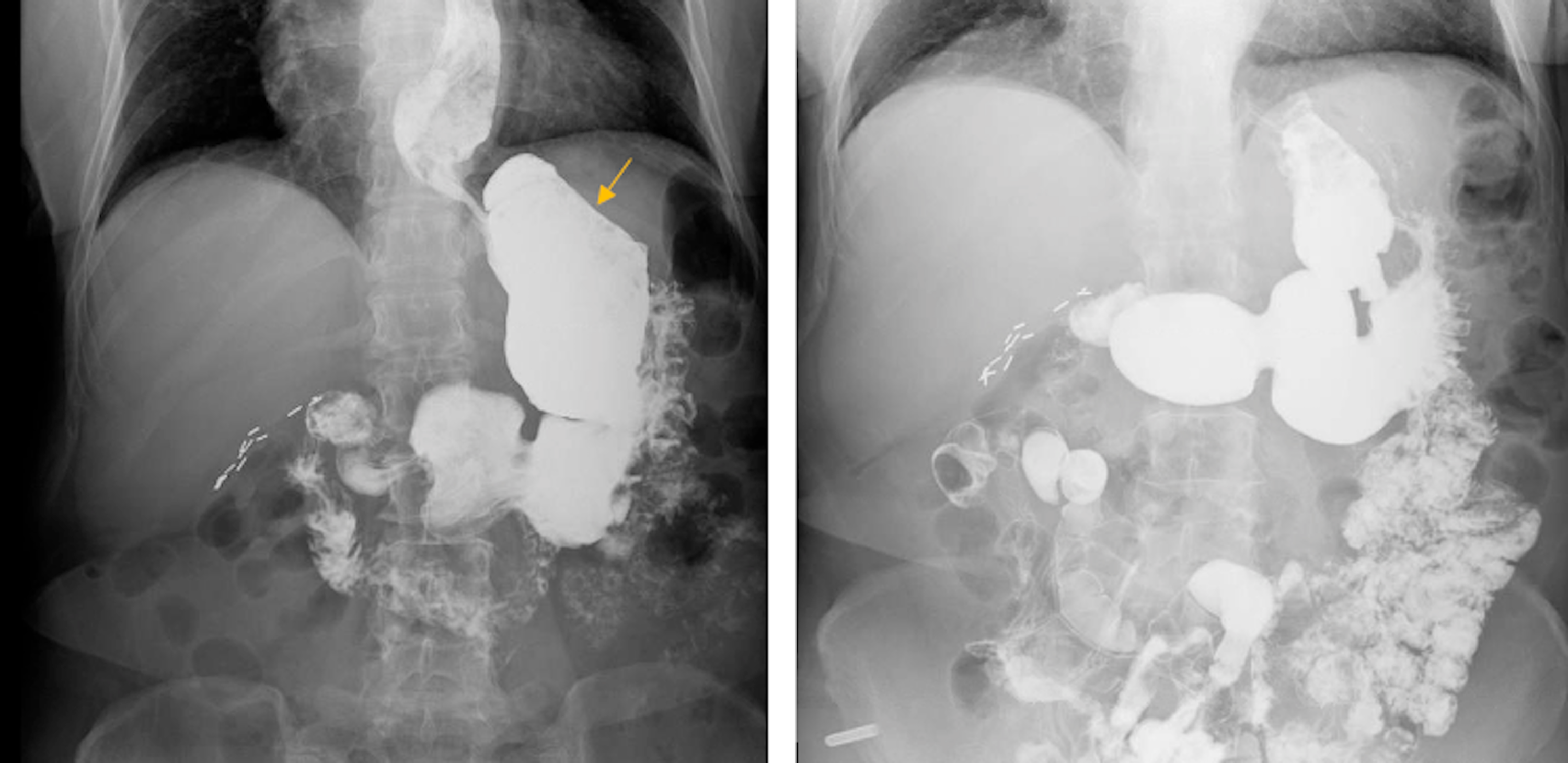 Cureus Gastric Bezoar Cause of Weight Loss in a Patient With