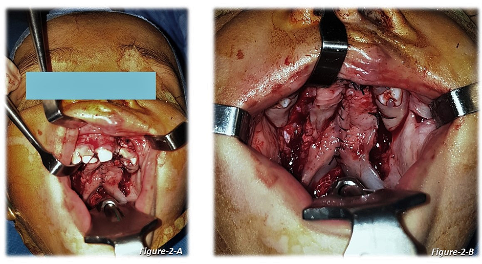 Cleft-palate-repair---continuous-suture-technique