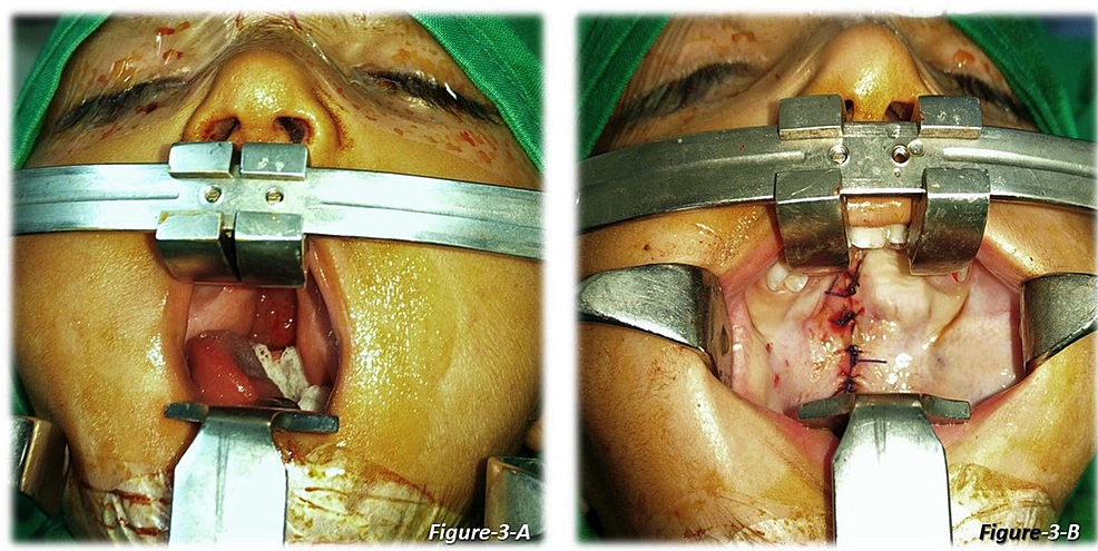 Cleft-palate-repair:-interrupted-suture-technique