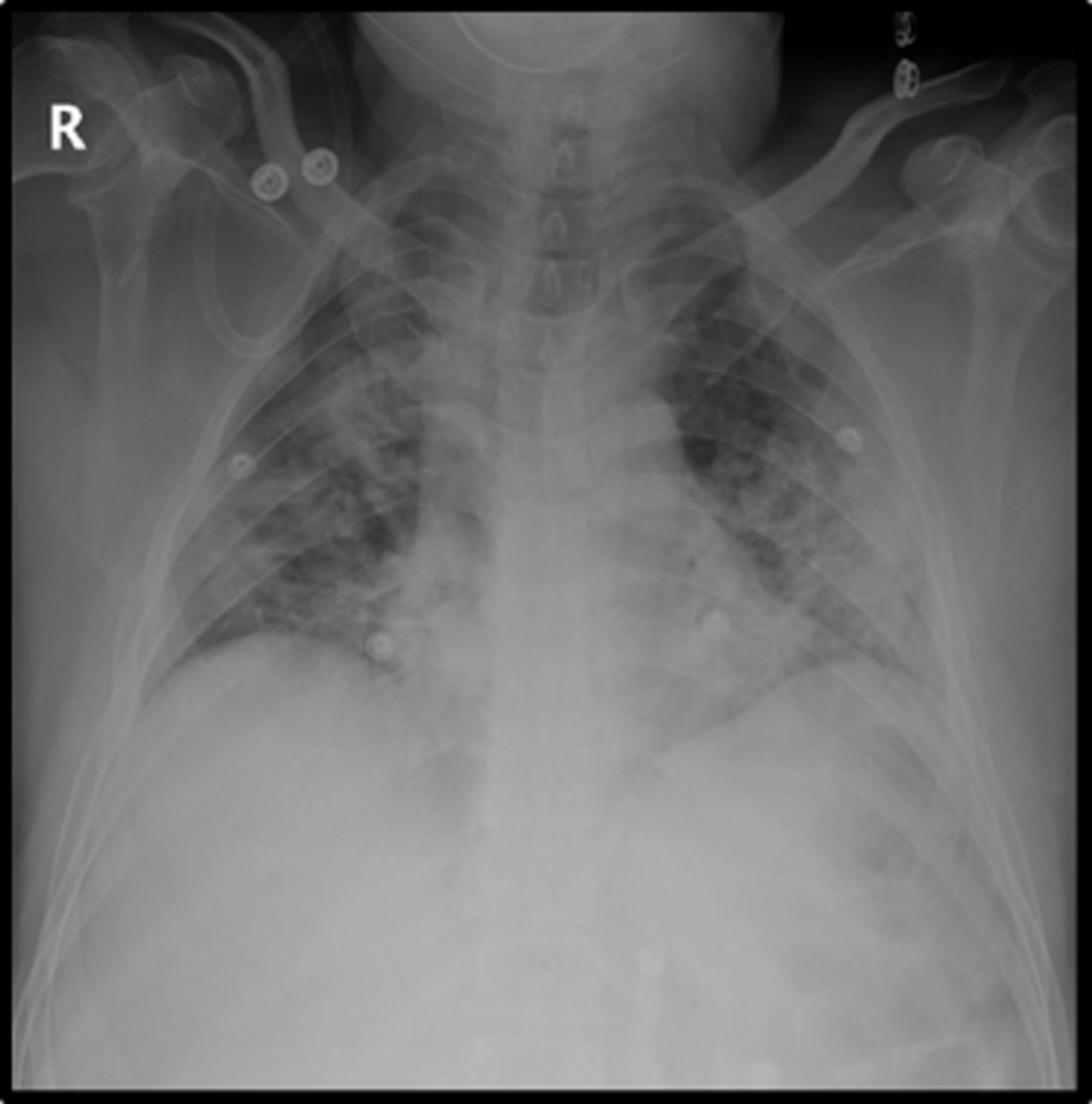 Cureus Lance Adams Syndrome A Rare Case Presentation of Myoclonus