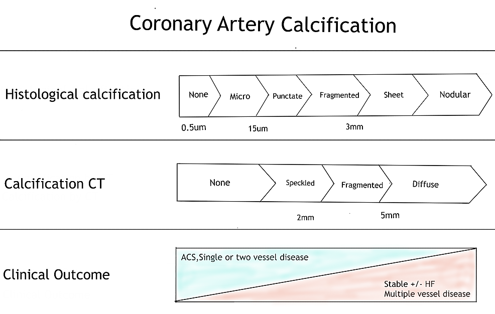 Cureus Coronary Artery Calcium Score A Reliable Indicator Of 