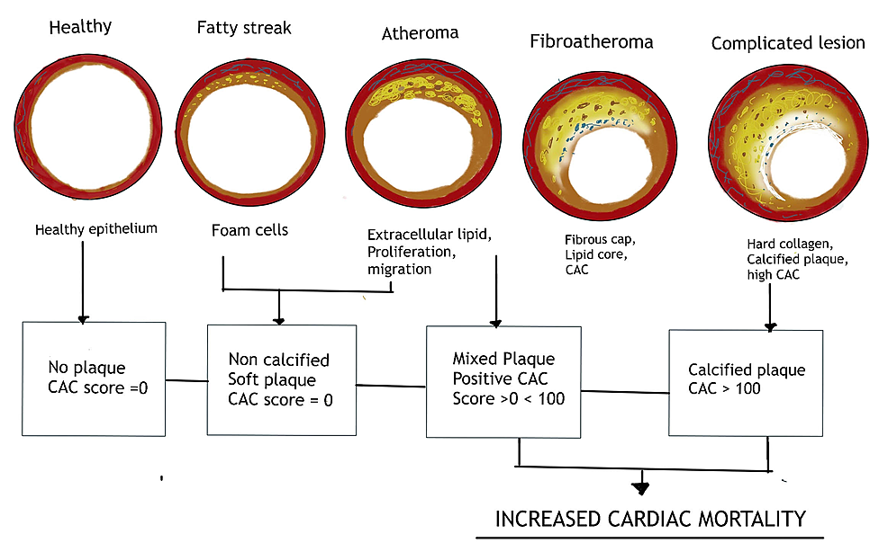 Cureus | Coronary Artery Calcium Score - A Reliable Indicator of ...