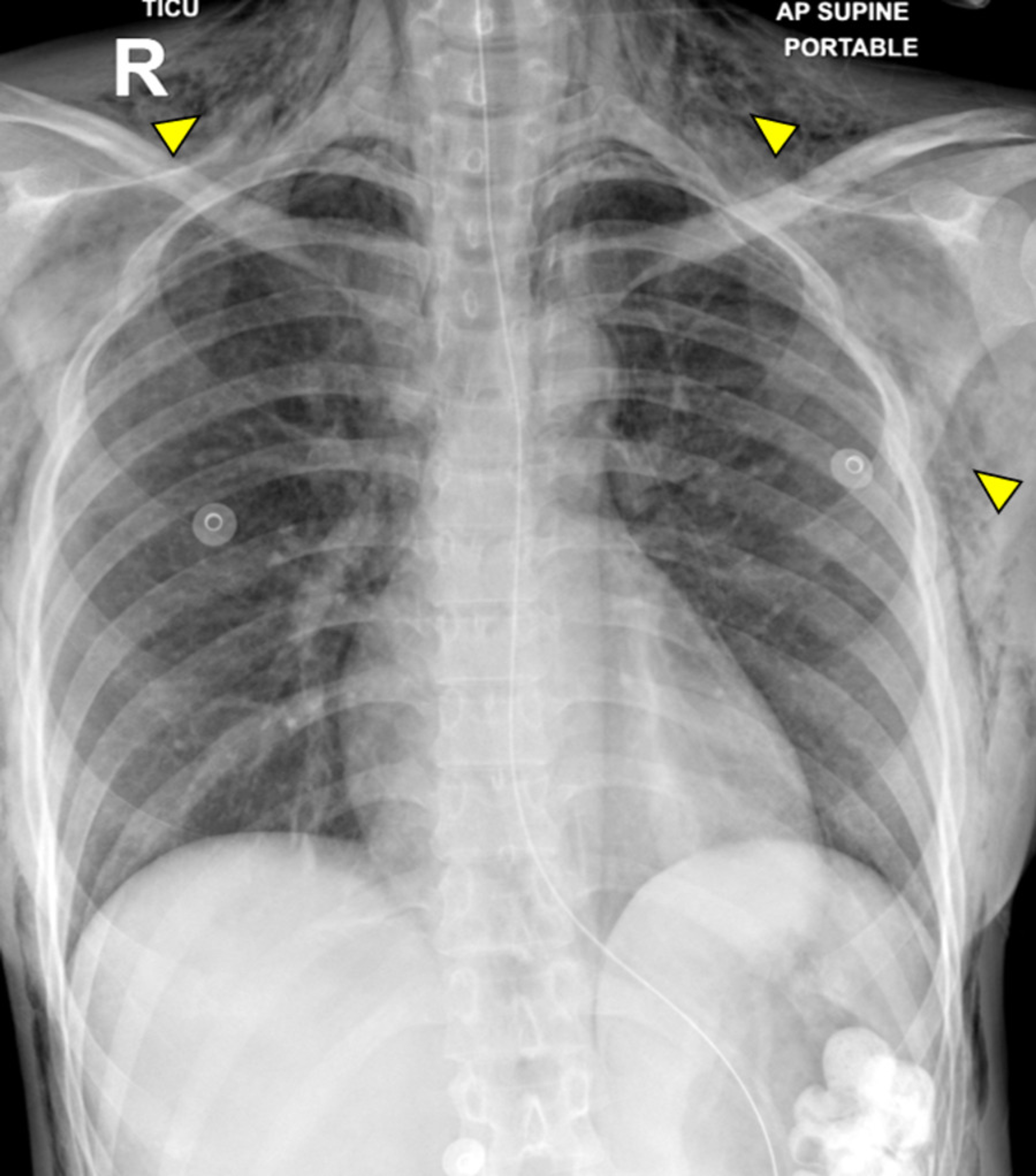 Cureus | Extensive Surgical Emphysema Following Stab Injury to the Neck