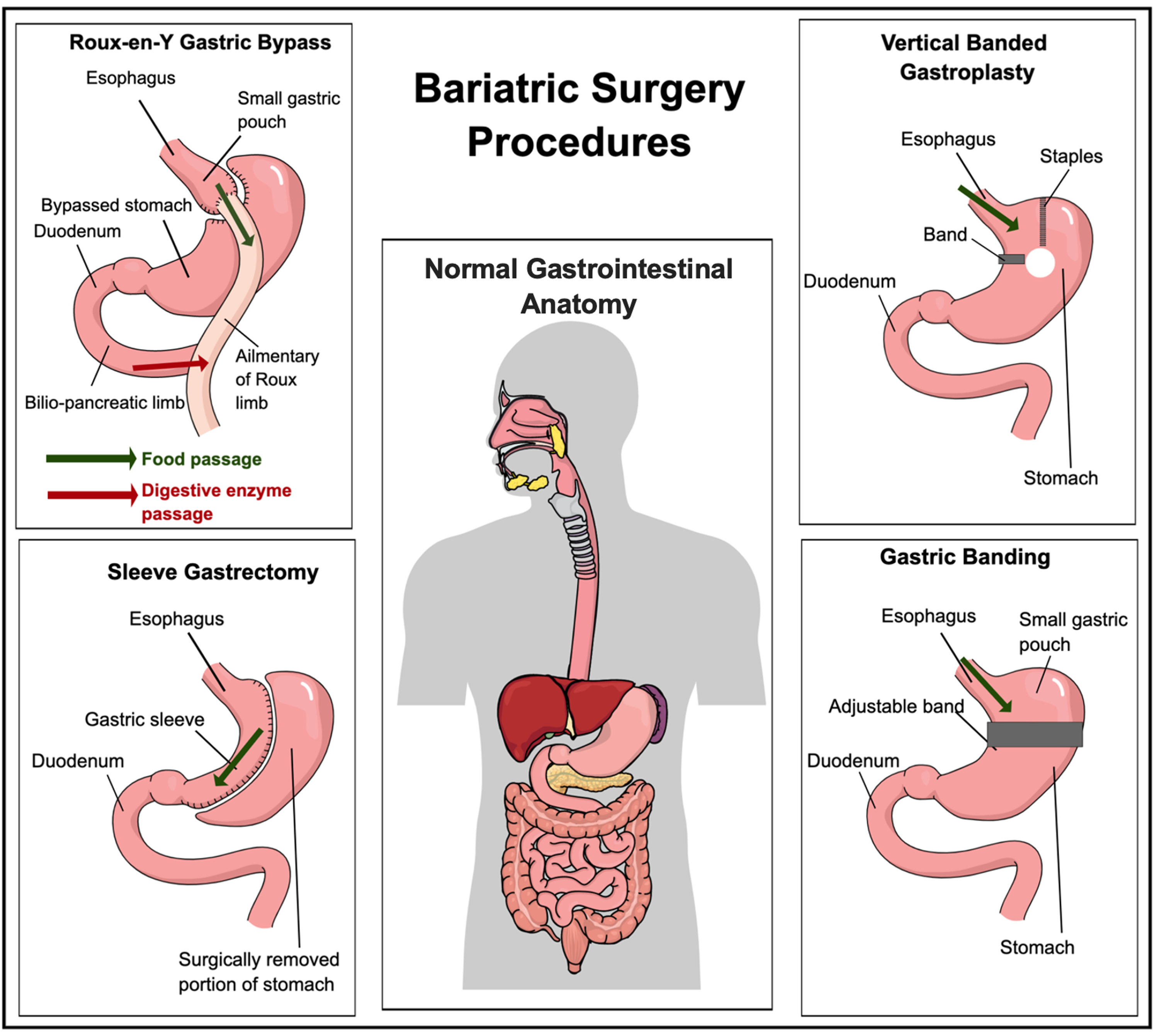 Cureus | The Impact Of Bariatric Surgery On Cardiovascular Risk Factors ...