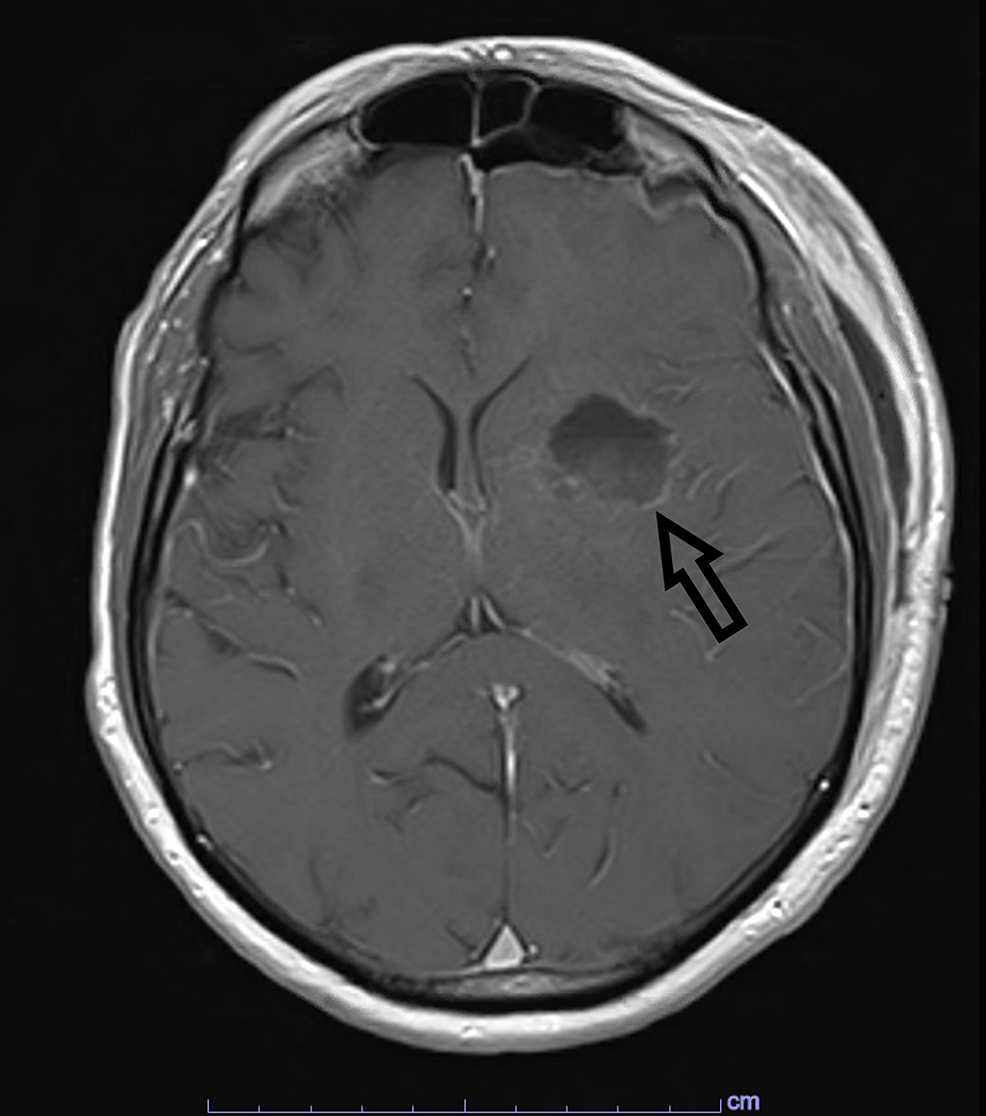 Post-operative,-T1-weighted,-axial-MRI-image-with-contrast-demonstrating-resected-left-frontal-lesion.