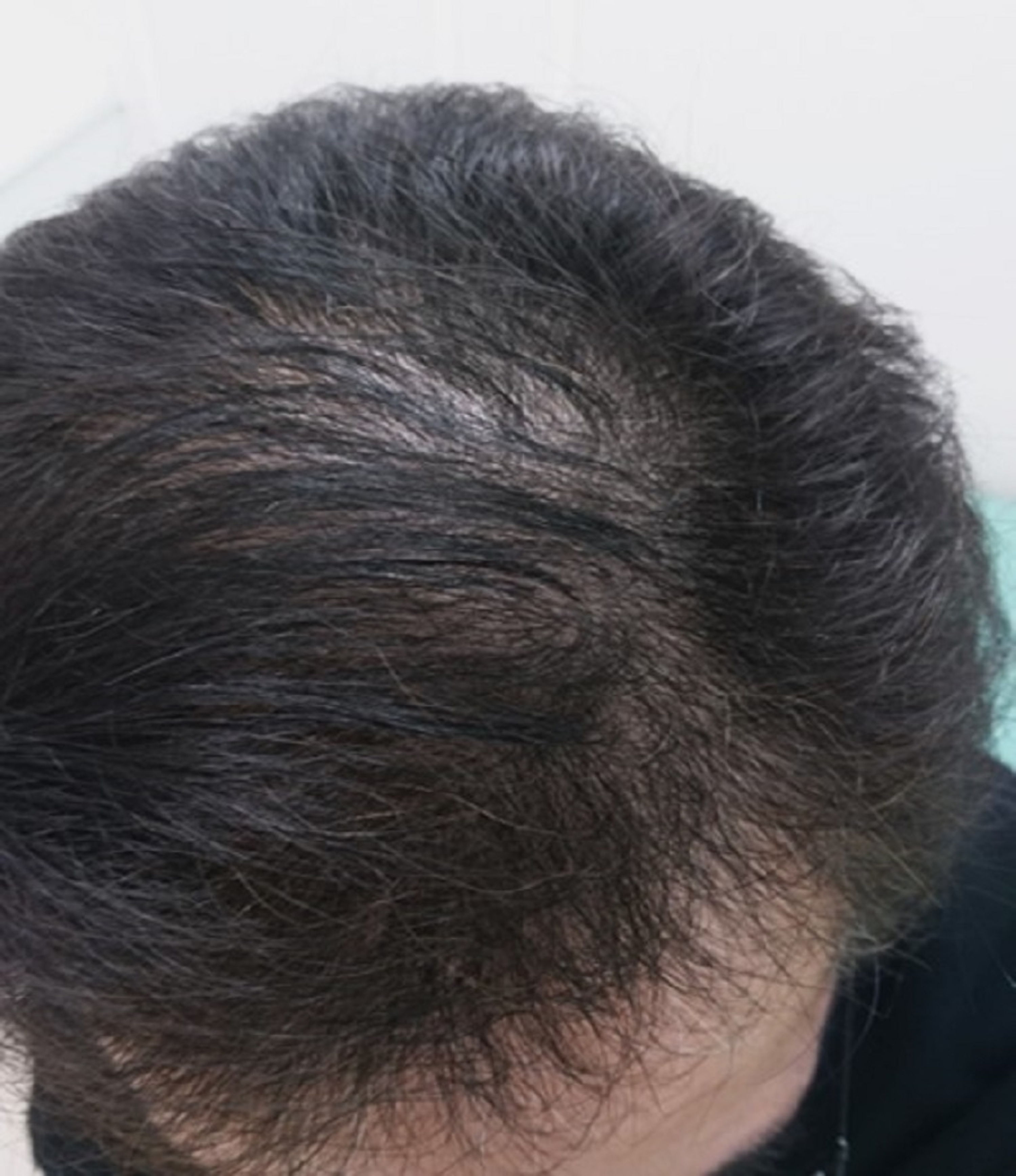 Cureus | Recovery From Alopecia After COVID-19 | Article