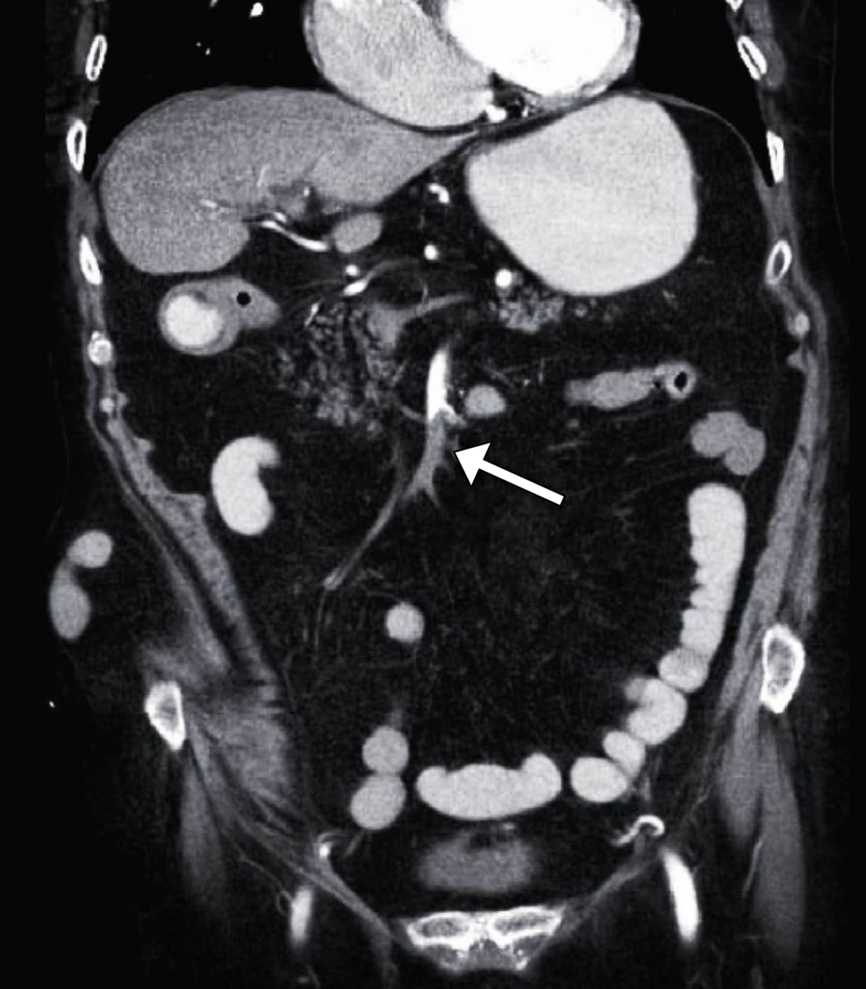 Cureus Superior Mesenteric Artery Thrombosis Following Severe Covid 19 Pneumonia Cureus Superior Mesenteric Artery Thrombosis Following Severe Covid 19 Pneumonia