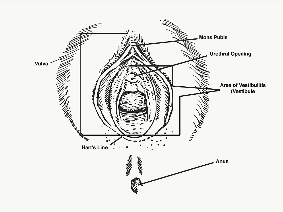 vulvar vestibulectomy