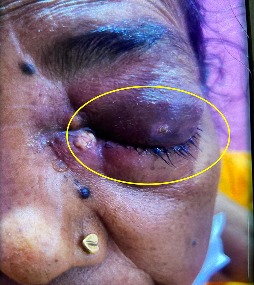 Left-periorbital-swelling-in-a-patient-of-mucormycosis