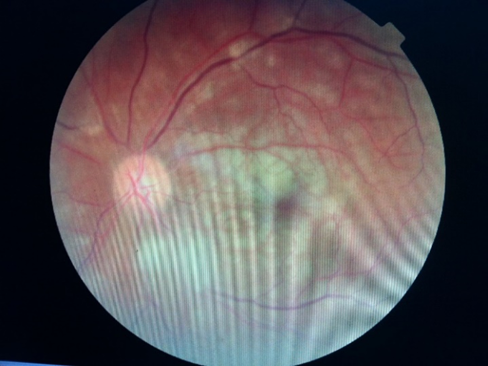 CRAO-in-left-eye-in-a-patient-with-mucormycosis