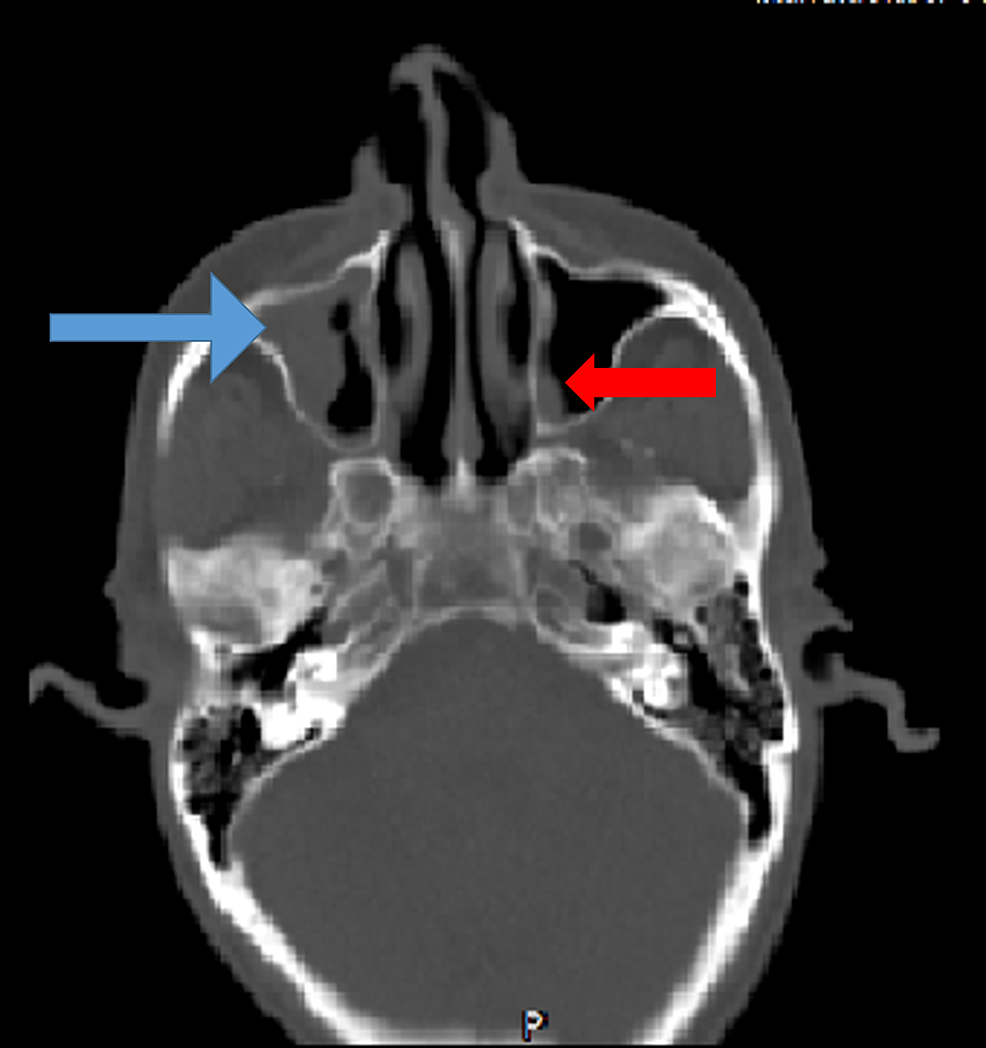 Axial-CT-head-showing-polypoidal-mucosal-thickening-of-right-maxillary-sinus-(blue-arrow)-and-focal-thickening-of-left-maxillary-sinus-(red-arrow)-