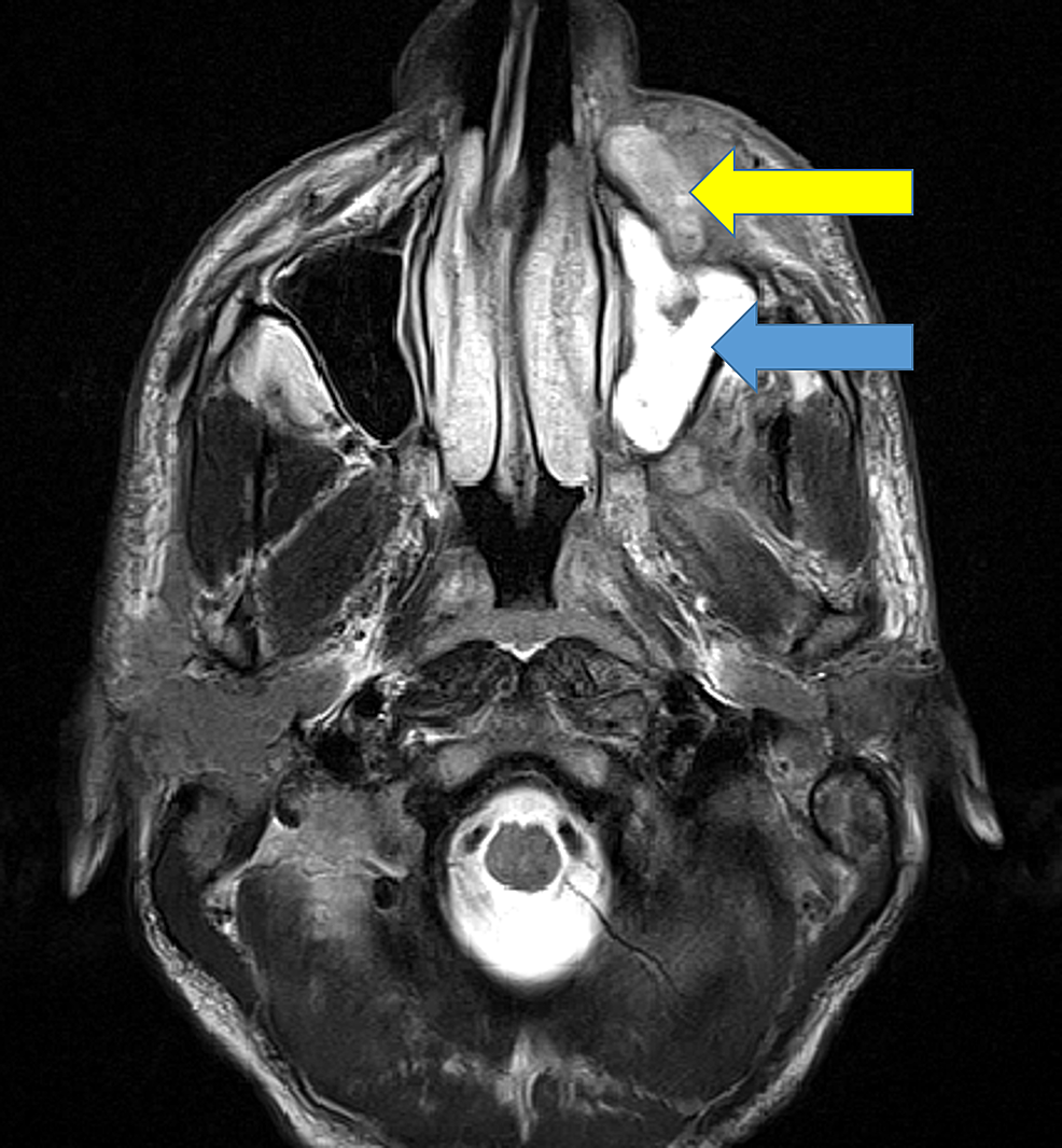 MRI-T2-weighted-axial-section-showing-mucosal-enhancement-of-left-maxillary-sinus-(blue-arrow)-with-left-cheek-abscess-(yellow-arrow)-anterior-to-the-maxillary-sinus--