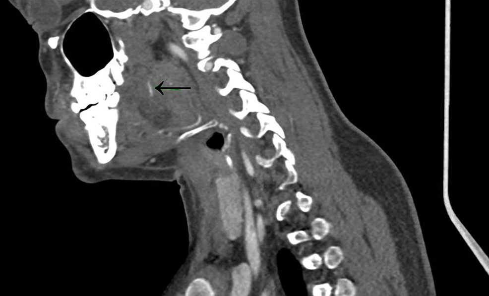 Submucosal Intraglossal Fish Bone Extraction A Case for the