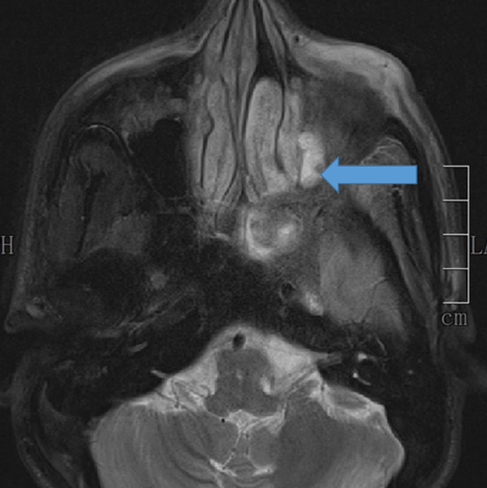 MRI--Fat-suppression-(FS)-image-showing-extra-conal-left-orbital-involvement
