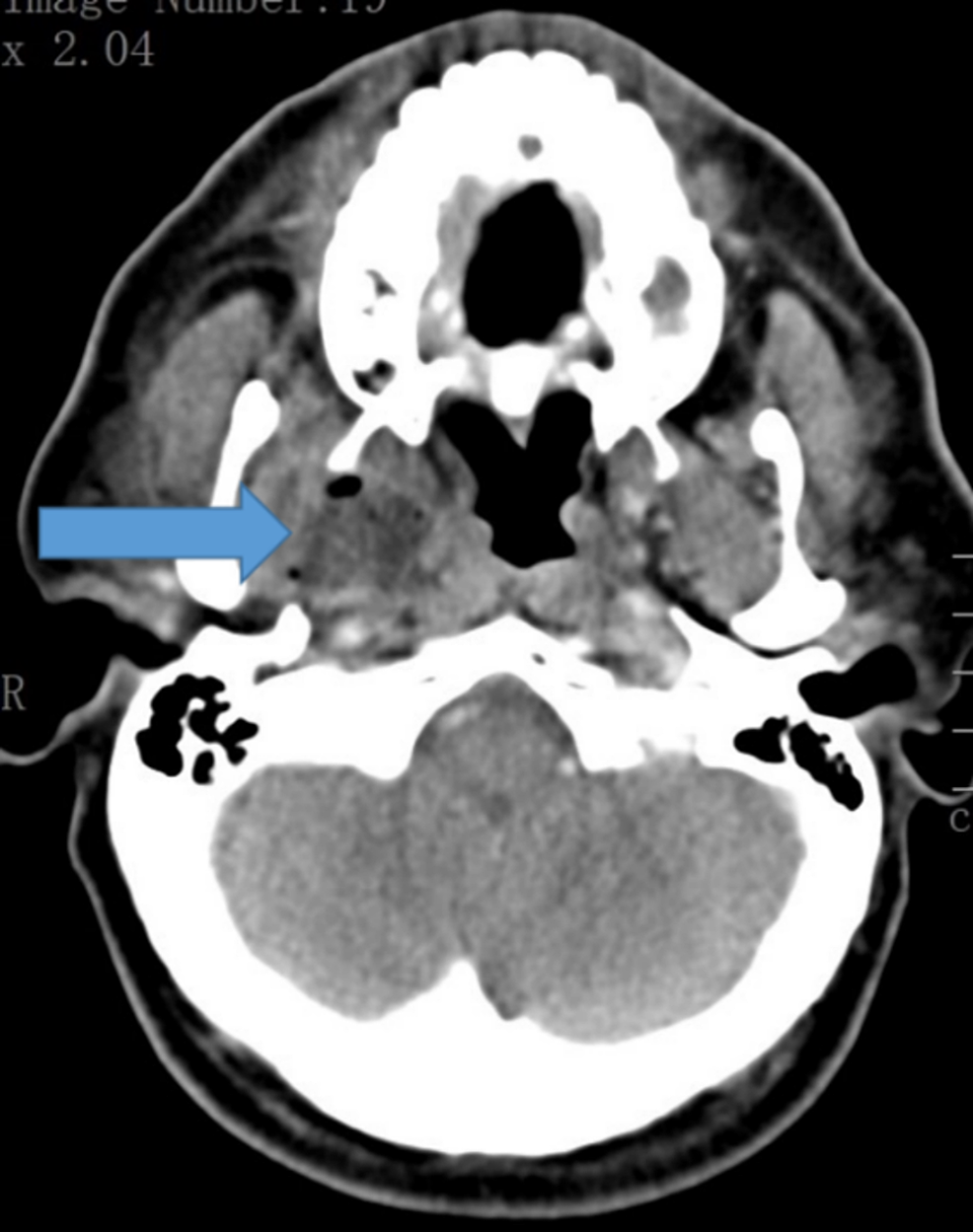 CT-scan-of-head---axial-view-showing-right-parapharyngeal-abscess