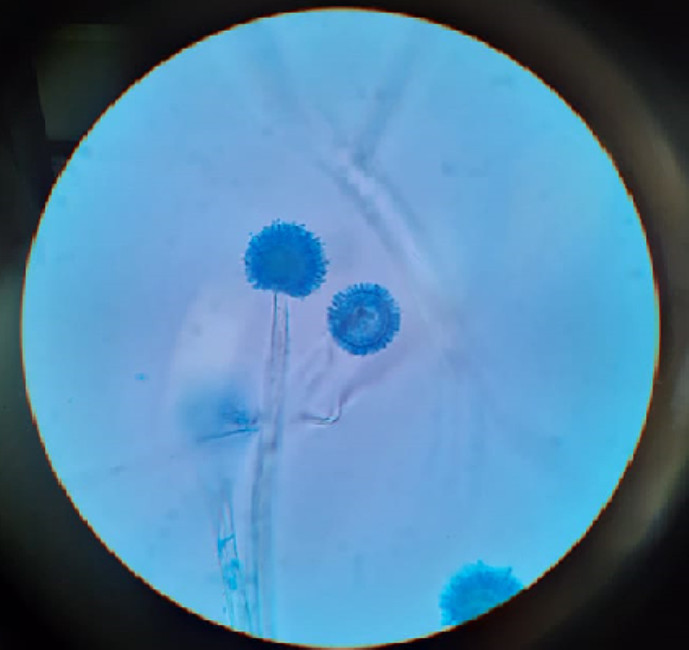 Photomicrograph-showing-aspergillus-from-the-nasal-biopsy-taken-from-patient-with-mucormycosis