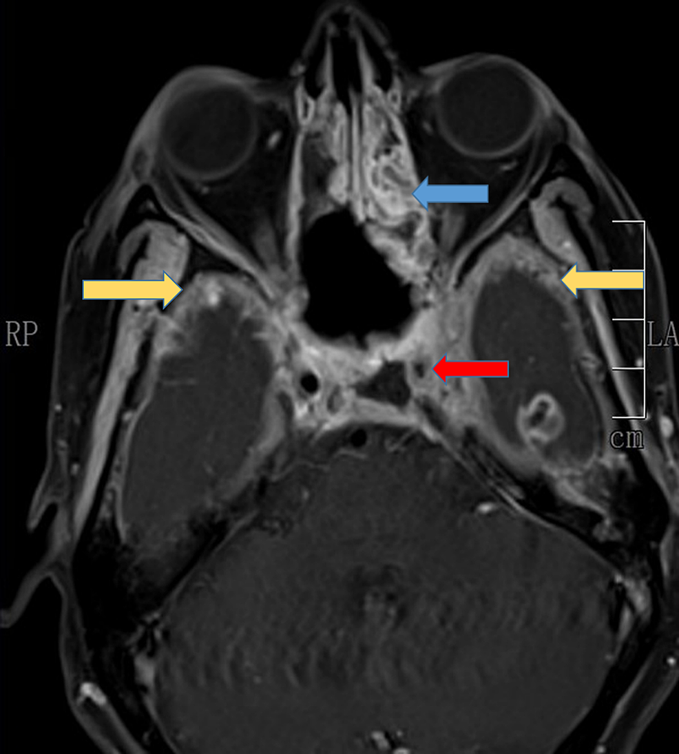 MRI-brain,-axial-view-showing-partial-thrombus-in-the-cavernous-portion-of-ICA-(red-arrow),-left-ethmoidal-sinusitis-(blue-arrow),-and-meningeal-enhancement-over-temporal-lobes-bilaterally-(yellow-arrow)