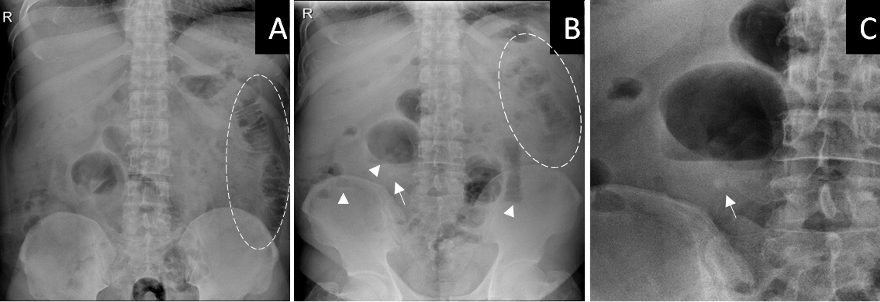Cureus | Meckel's Diverticulum Enterolith: A Rare Cause of Perforation and  Small Bowel Obstruction Presenting as Acute Abdomen