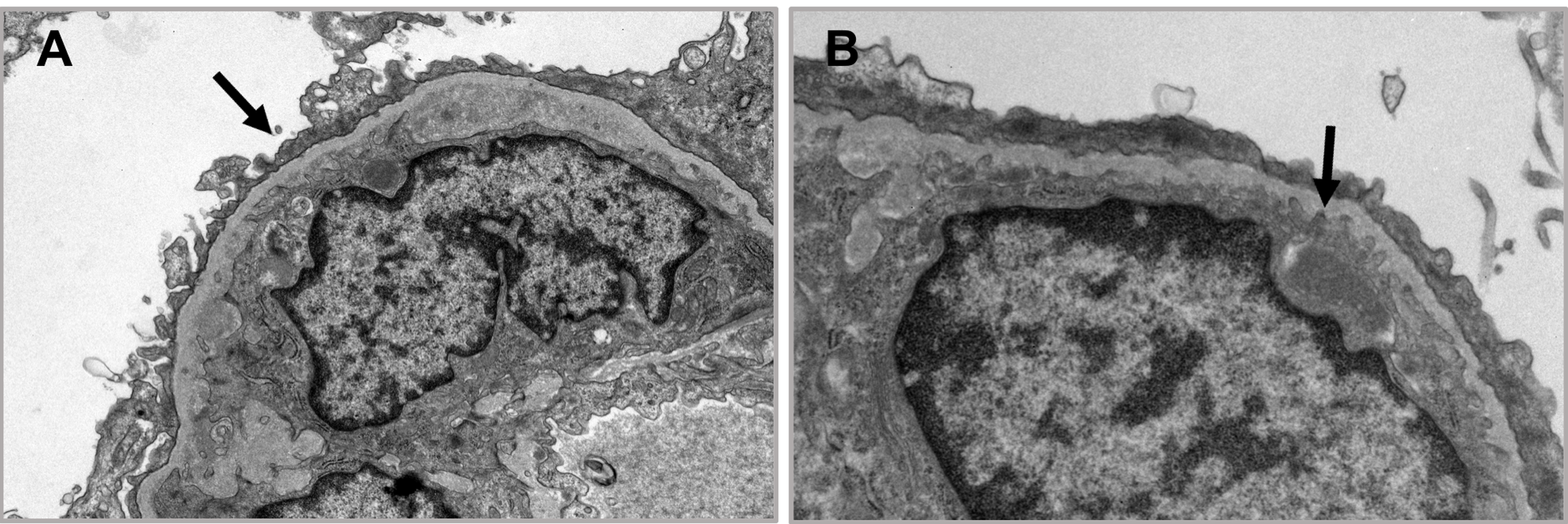 Cureus | Dasatinib-Induced Nephrotic Syndrome: A Case Report | Article