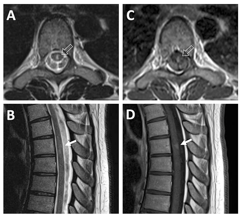 Images-(A)-and-(B):-Axial-and-sagittal-T2-weighted-sequences-showing-a-centrally-located-short-segment-T2-hyperintense-cord-lesion-without-associated-mass-effect.-This-is-less-well-seen-on-the-sagittal-image-due-to-its-narrow-transverse-diameter.-Images-(C)-and-(D):-Post-gadolinium-T1-weighted-images-showing-moderate-enhancement-of-the-same-lesion.