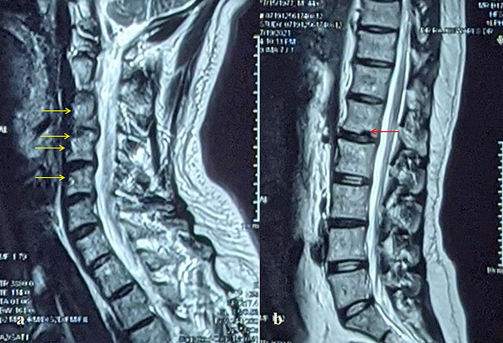 The Involvement of Temporomandibular Joint in Psoriatic Arthritis A