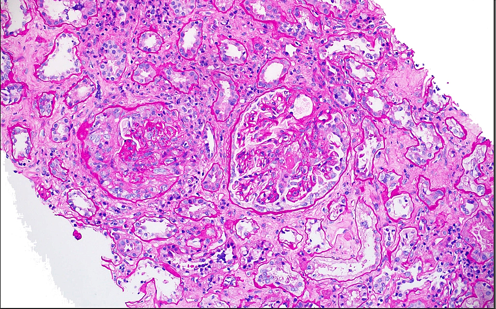 ANCA-Associated Vasculitis In A Patient Presenting With Rapid ...