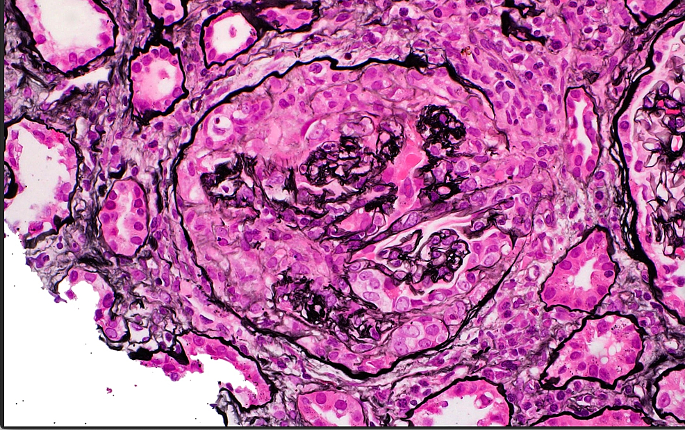 ANCA-Associated Vasculitis In A Patient Presenting With Rapid ...