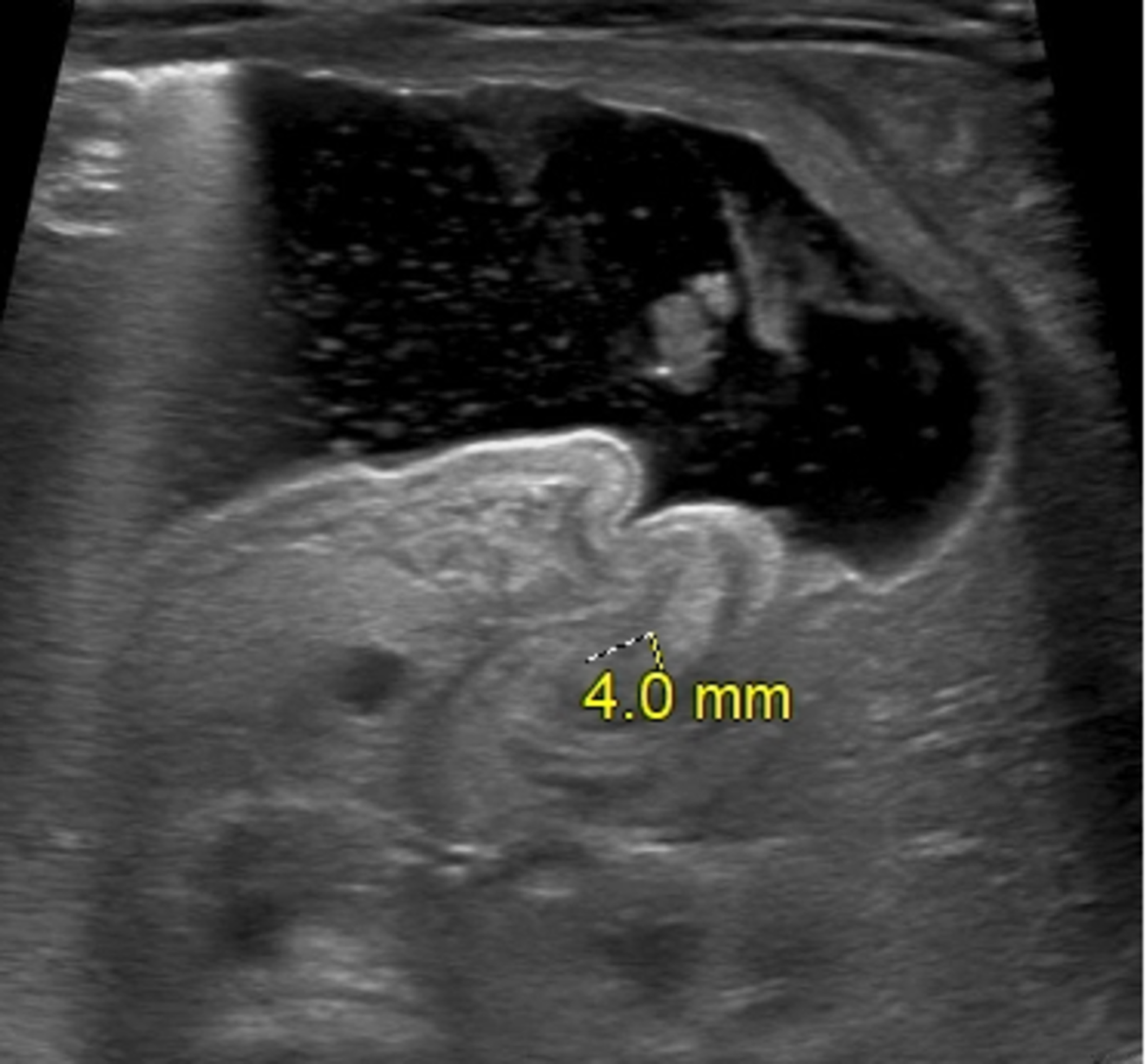 pyloric-stenosis-ultrasound