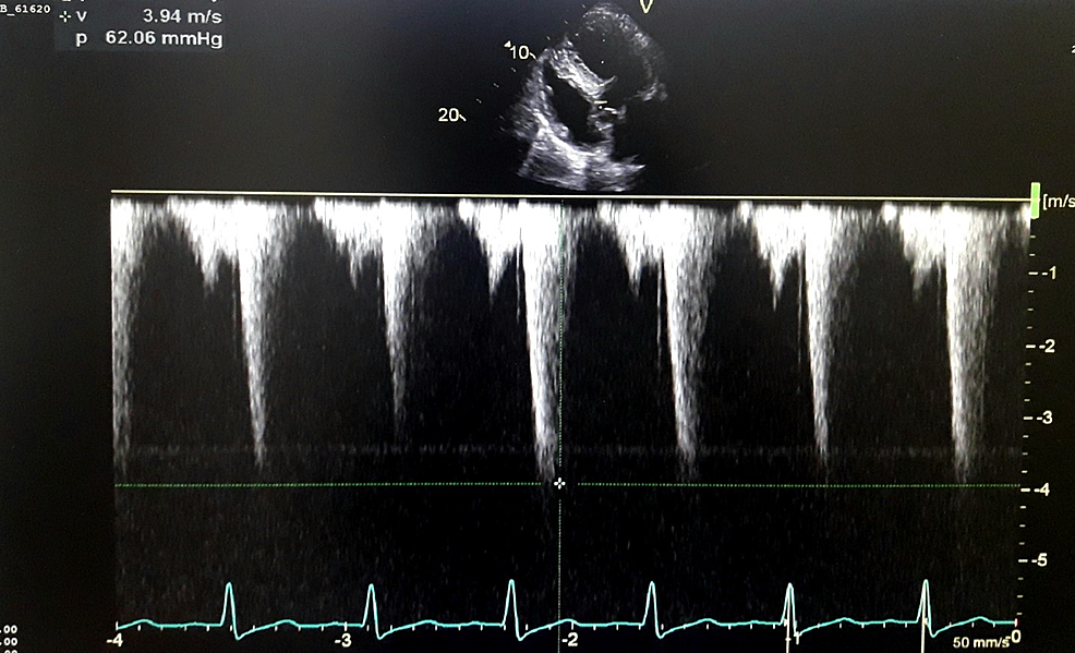 Cureus | Subaortic Membrane With Mitral Chordae Rupture Mimicking Left ...