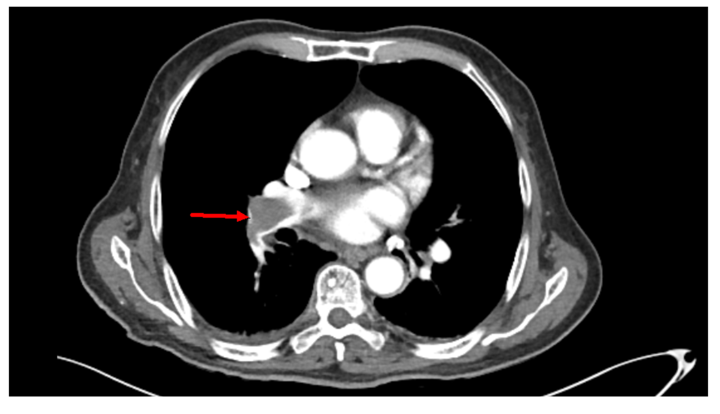 Cureus Incidental Finding Of Saddle Pulmonary Embolism On A Ct Scan Of The Abdomen And Pelvis 2536