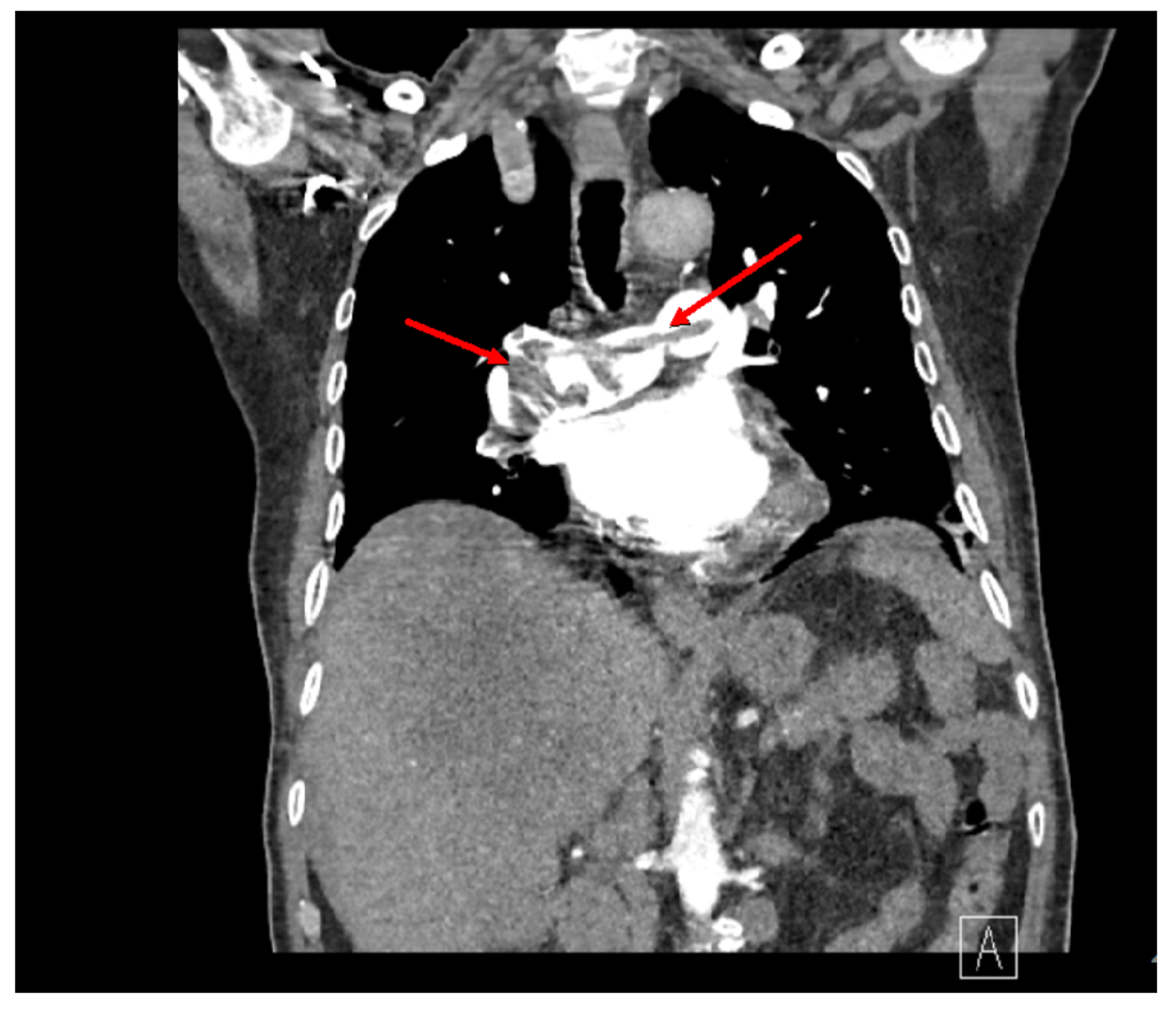 Cureus Incidental Finding Of Saddle Pulmonary Embolism On A Ct Scan Of The Abdomen And Pelvis 